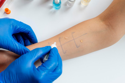 Medical professional applying drops for a skin allergy test on a marked arm.