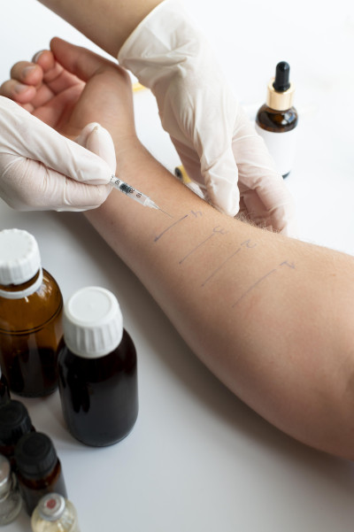 Allergy test on the arm with injection, performed by a gloved person.