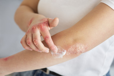 Patientin behandelt PSORIASIS mit Creme