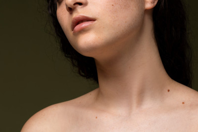 Close-up of a young woman’s neck and chin with visible moles.