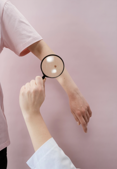 Magnifying glass examines mole on arm.