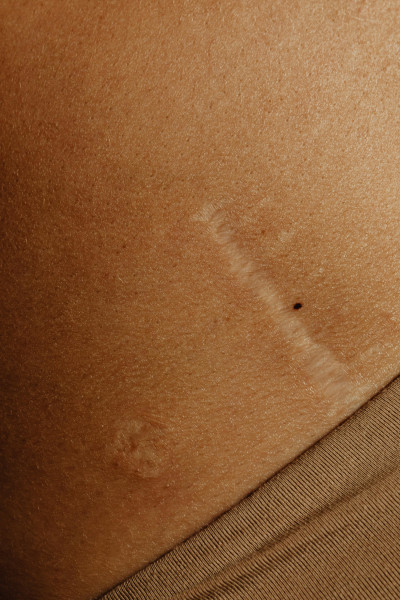 Close-up of a scar on the skin.